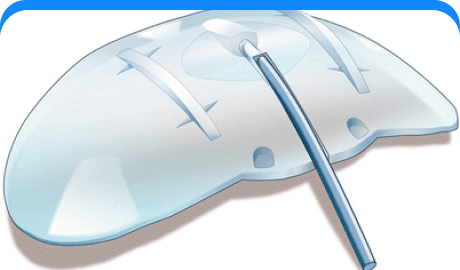 Glaucoma Drainage Devices
