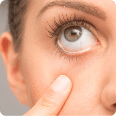 Dry Eye