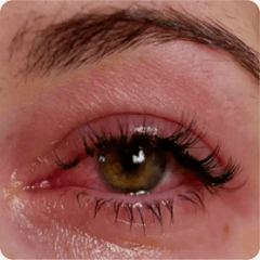 Redness & Tearing