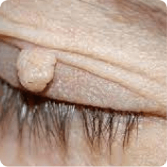 Bumps & growths
