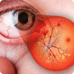 Diabetic Retinopathy