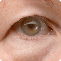 Droopy eyelids