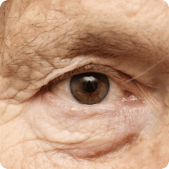 Glaucoma