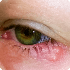 Infection
