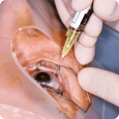 Macular Degeneration