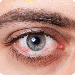 Red eye