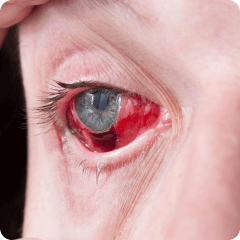 Eye Injury