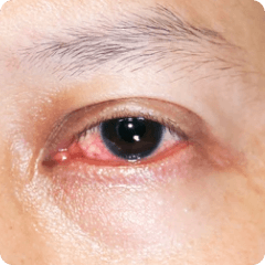 ocular infetcion