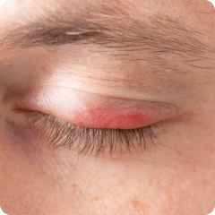 ocular inflamation