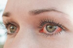 Eye Allergies