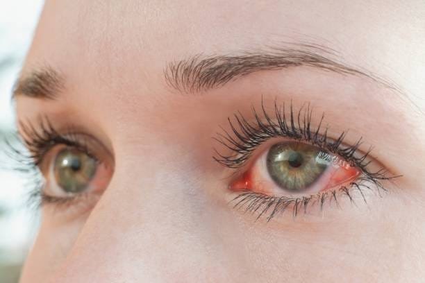 Eye Allergies